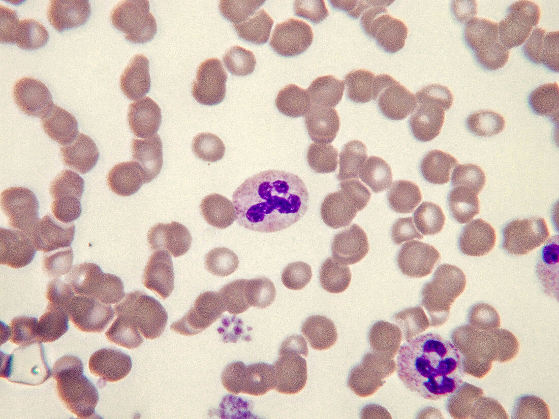 Rouleaux red blood cells, LM