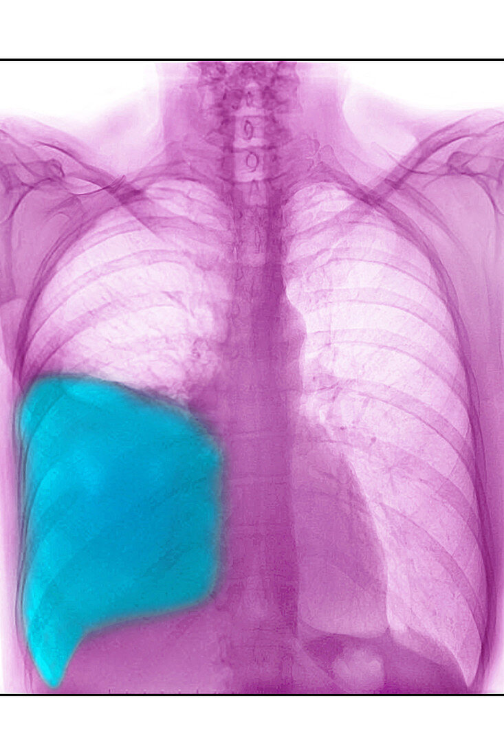 Pleurisy, X-ray