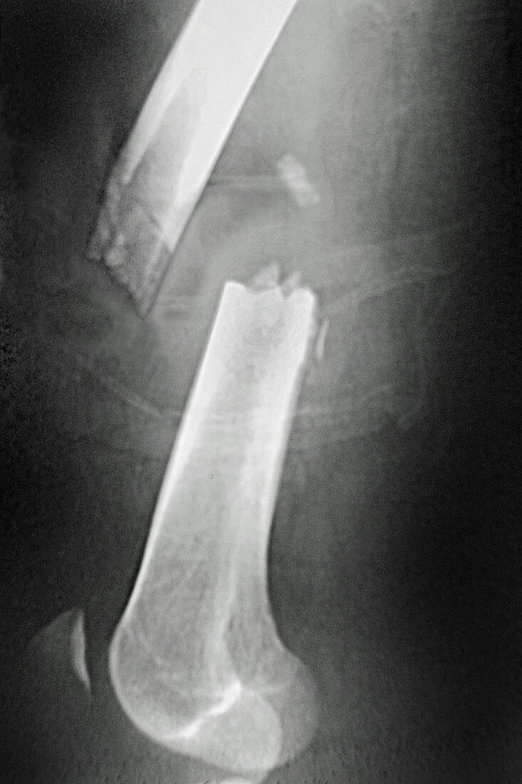 Femoral Fracture, X-ray