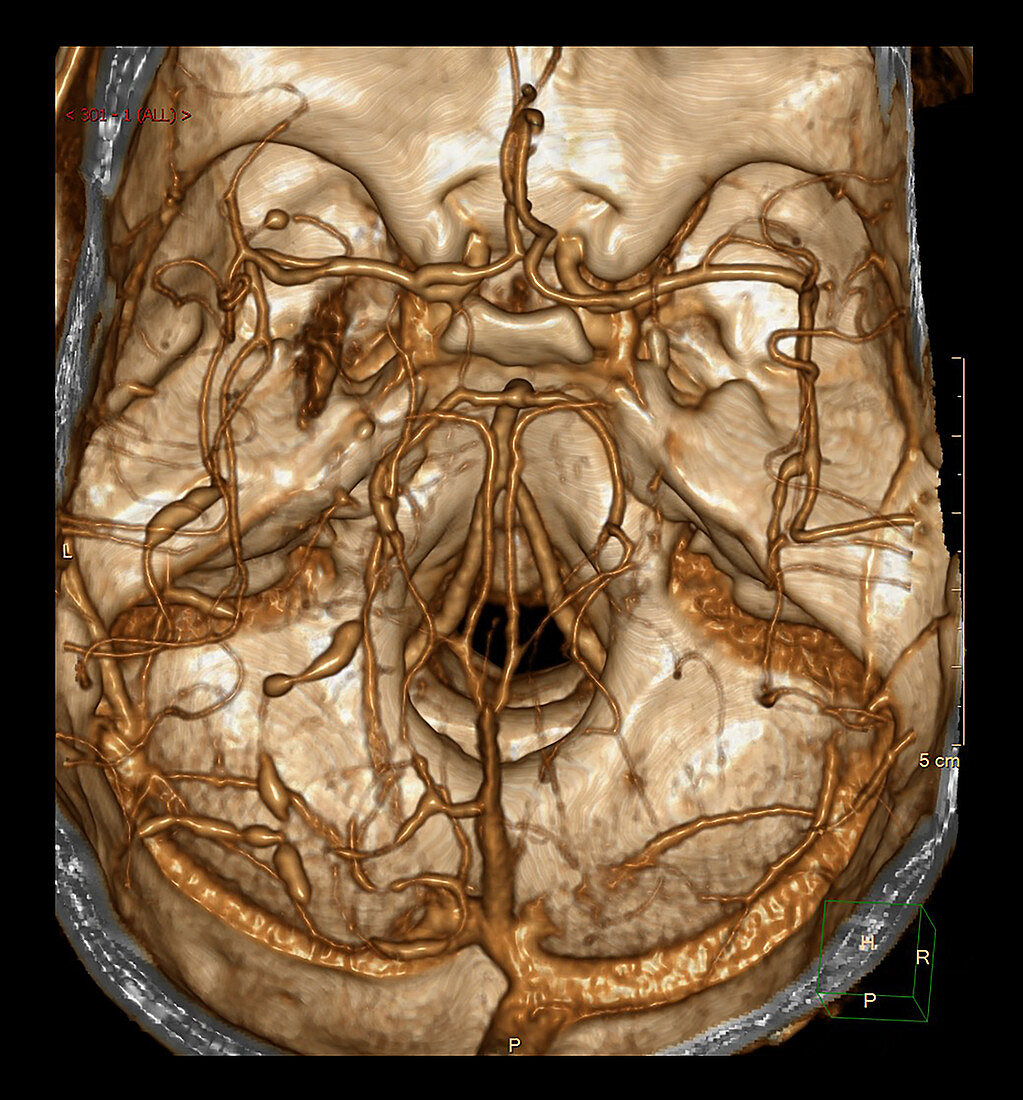 Cerebral Vasculitis on 3D CTA