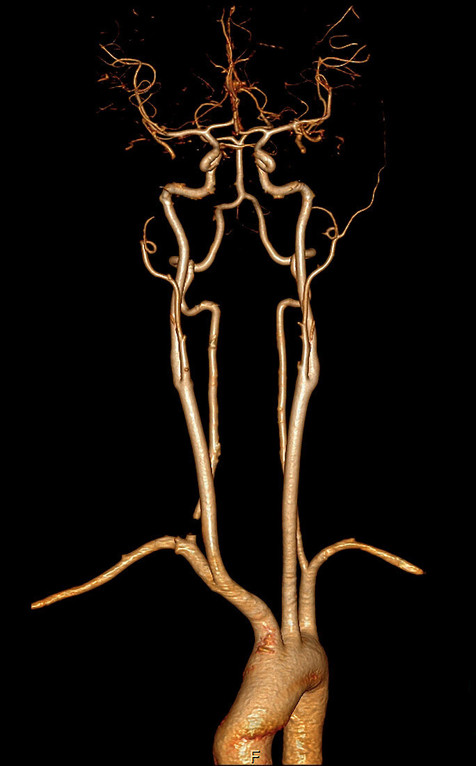 3D CTA of Aortic Arch and Neck Vessels