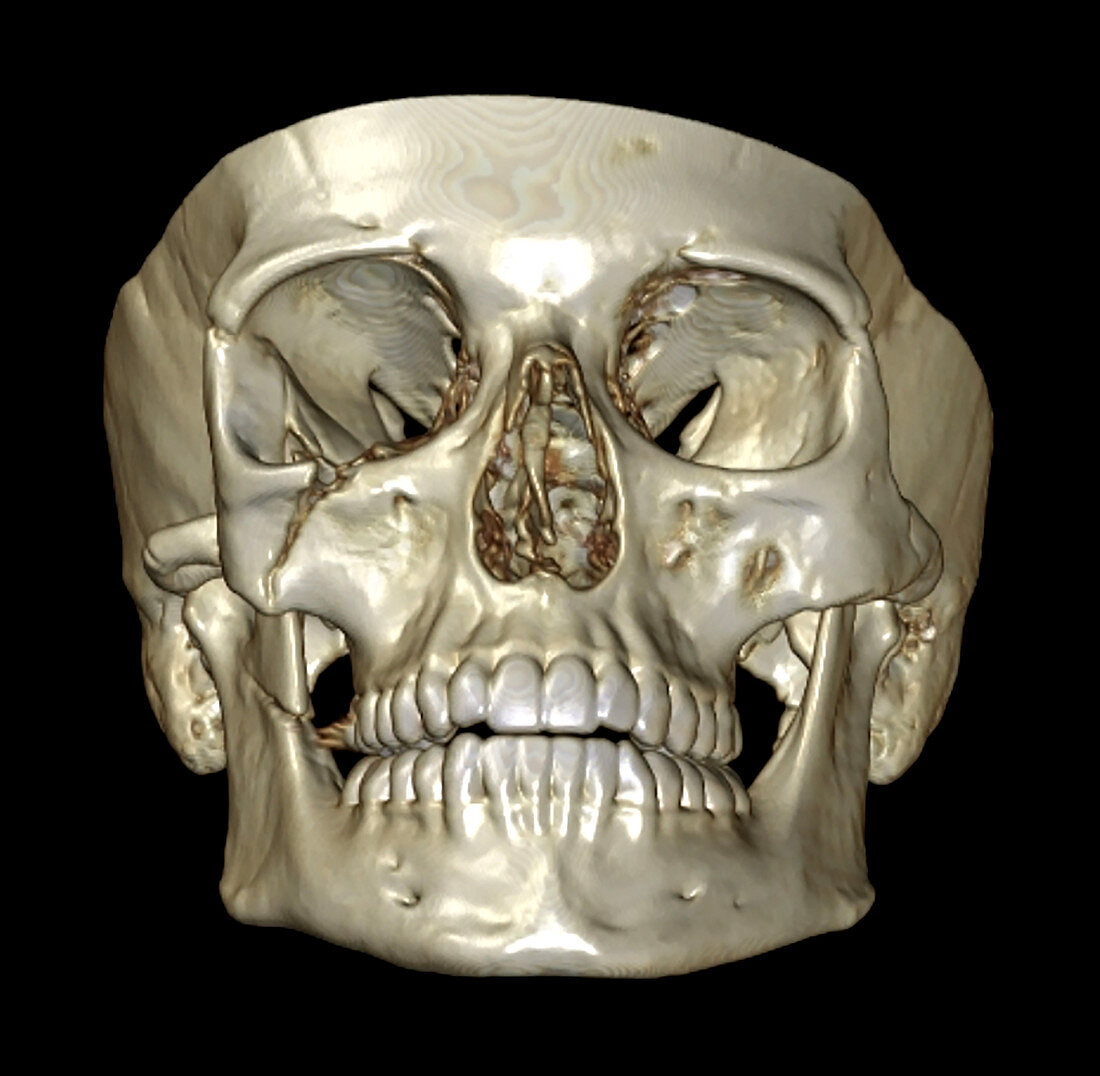 3D CT of Zygomaticomaxillary Complex Fracture
