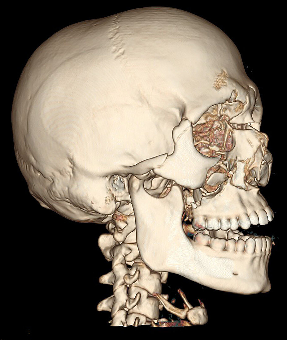 3D CT of Lefort Facial Fractures