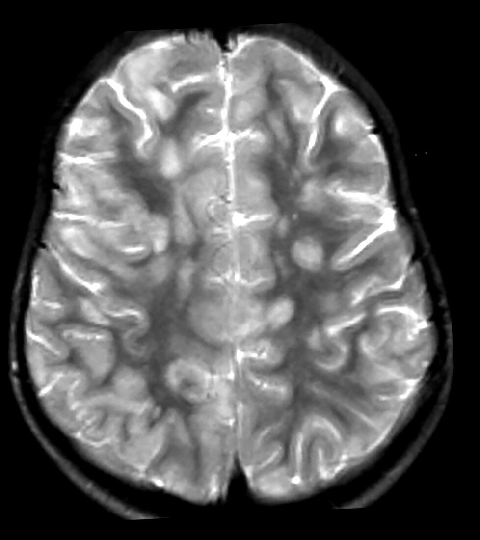 MRI of ADEM