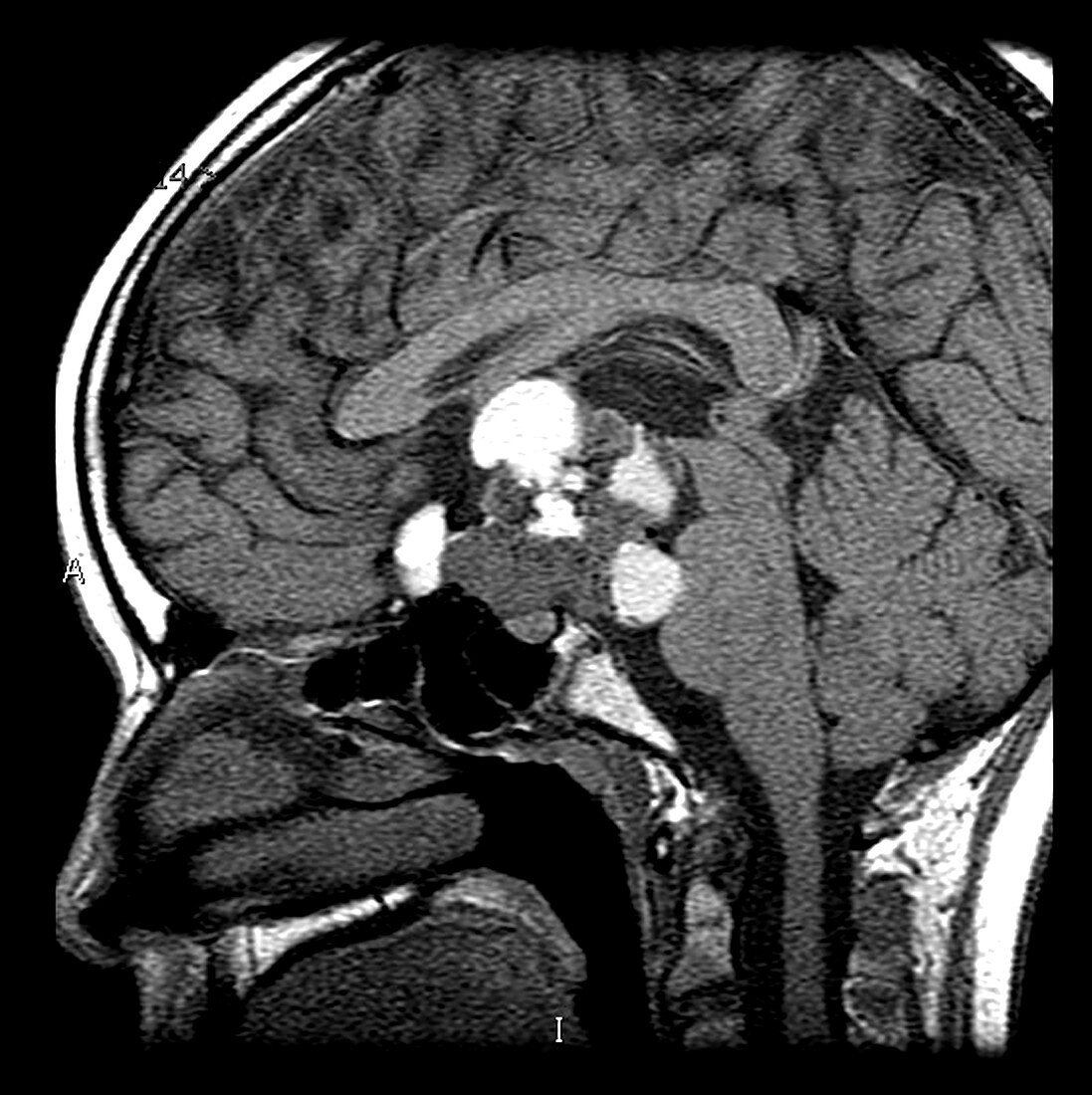 MRI of Craniopharyngioma