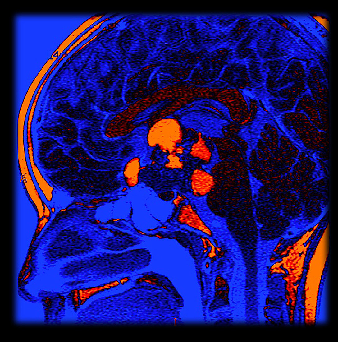 Enhanced MRI of Craniopharyngioma