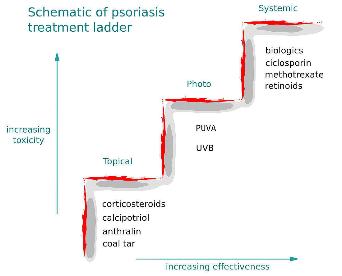 Treatment Ladder for Psoriasis, Diagram