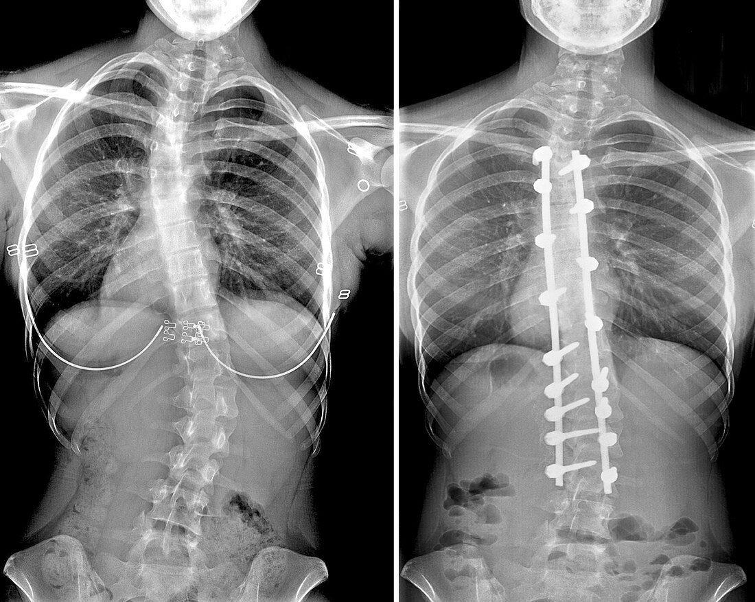 Scoliosis, Before and After Surgery, X-Ray