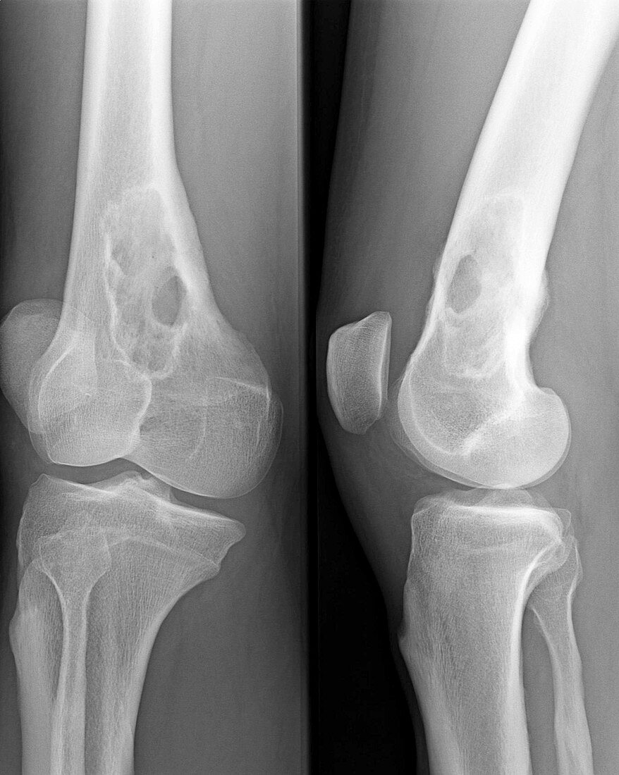 Lytic Lesion in Femur, X-Ray