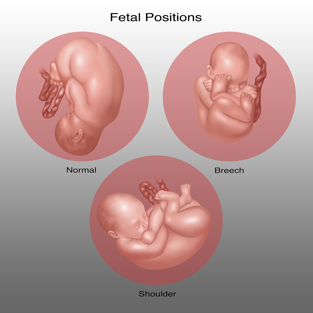 Fetus Positions in Uterus, Illustration