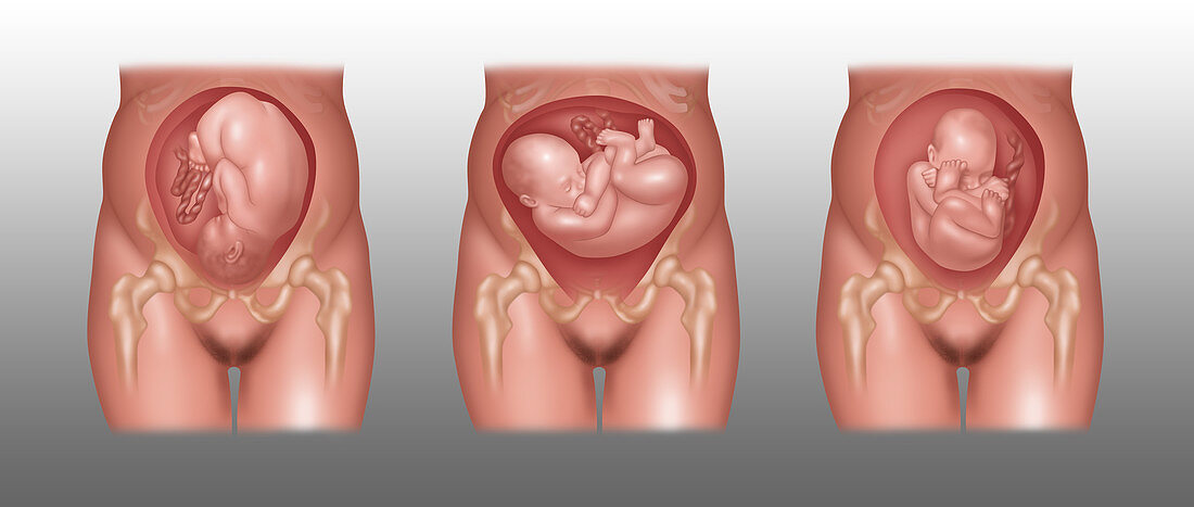 Fetus Positions in Uterus, Illustration