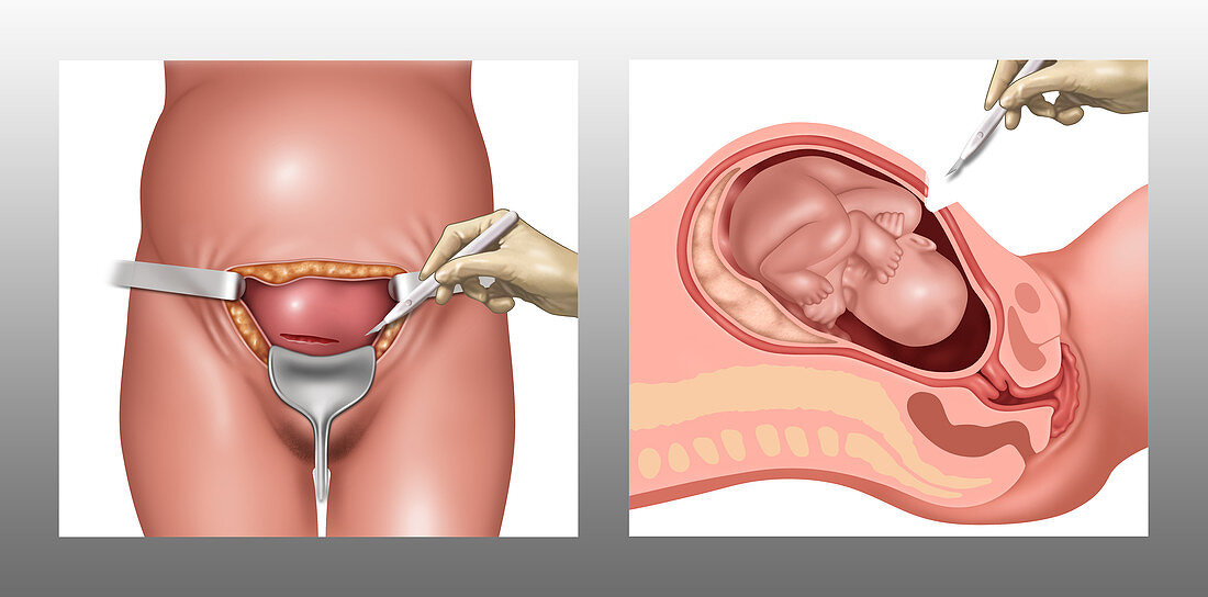 Cesarean Section Incisions, Illustration