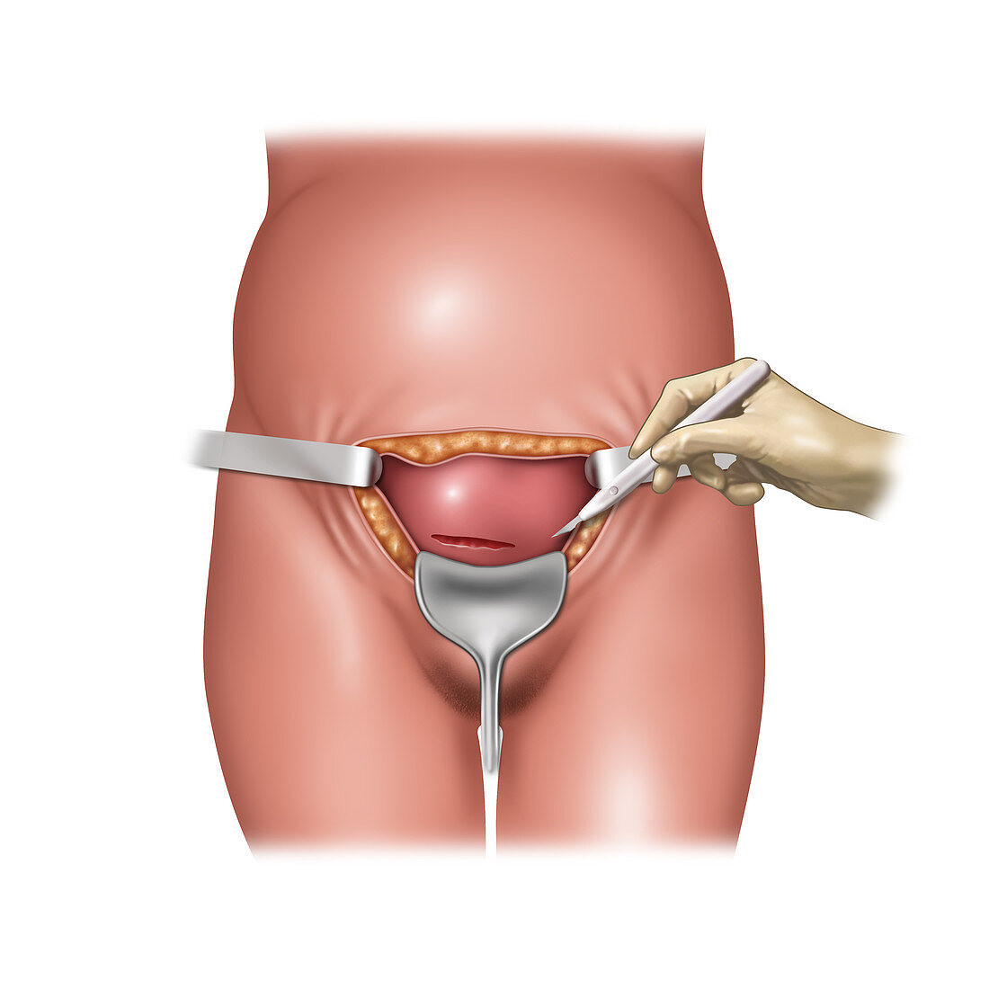 Cesarean Section Incisions, Illustration