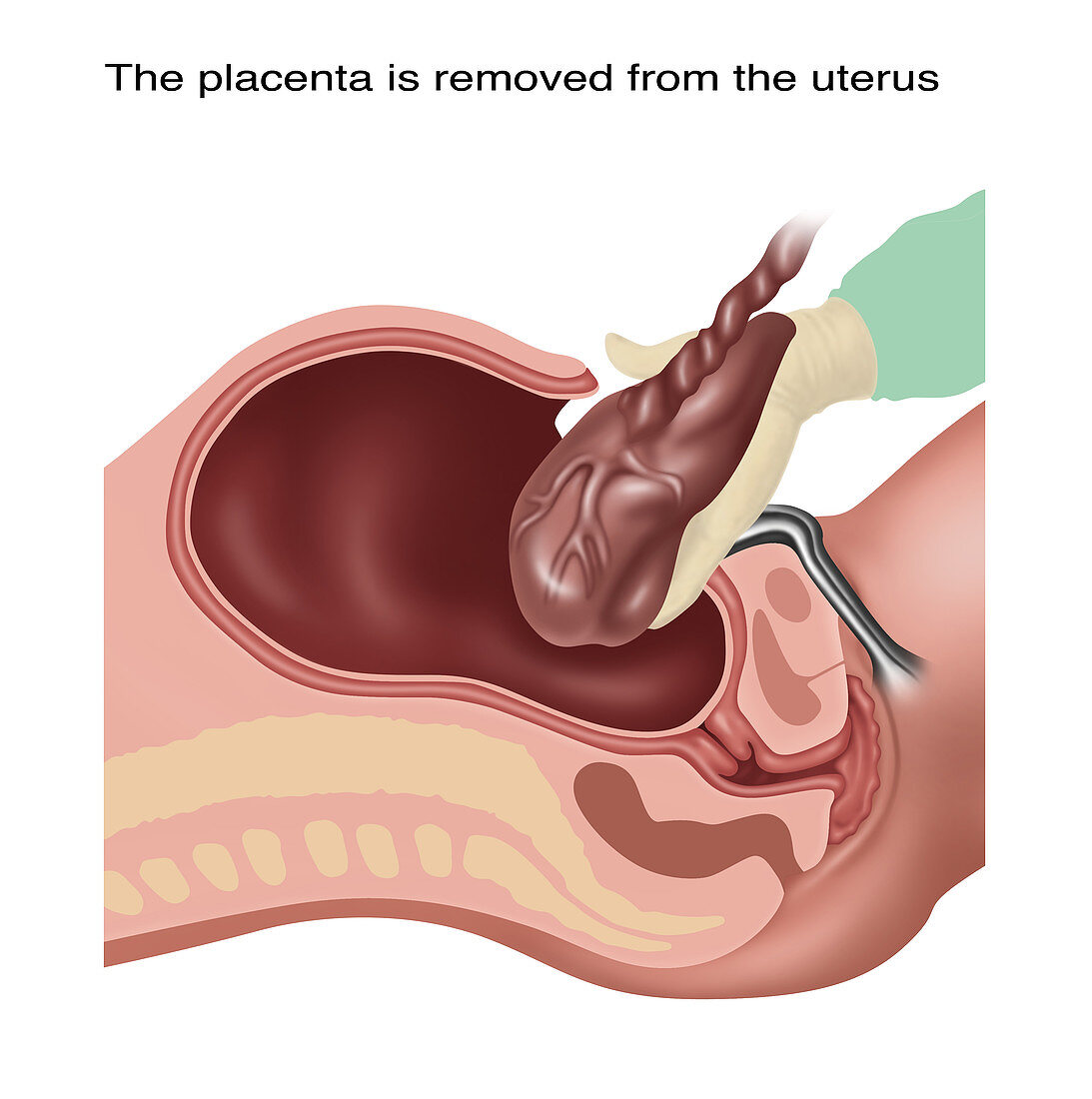 Cesarean Section Steps, Illustration, 3 of 4