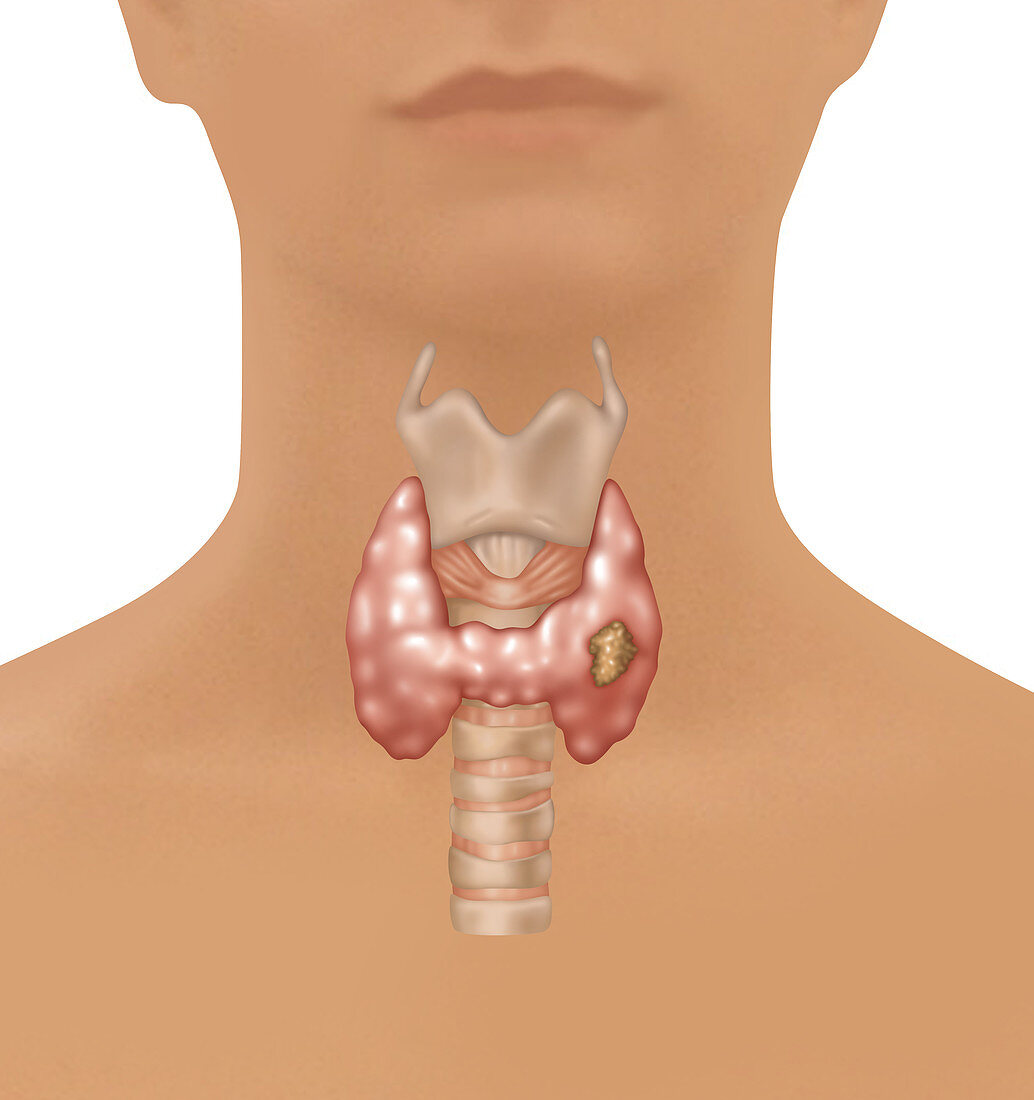 Thyroid Cancer, Illustration