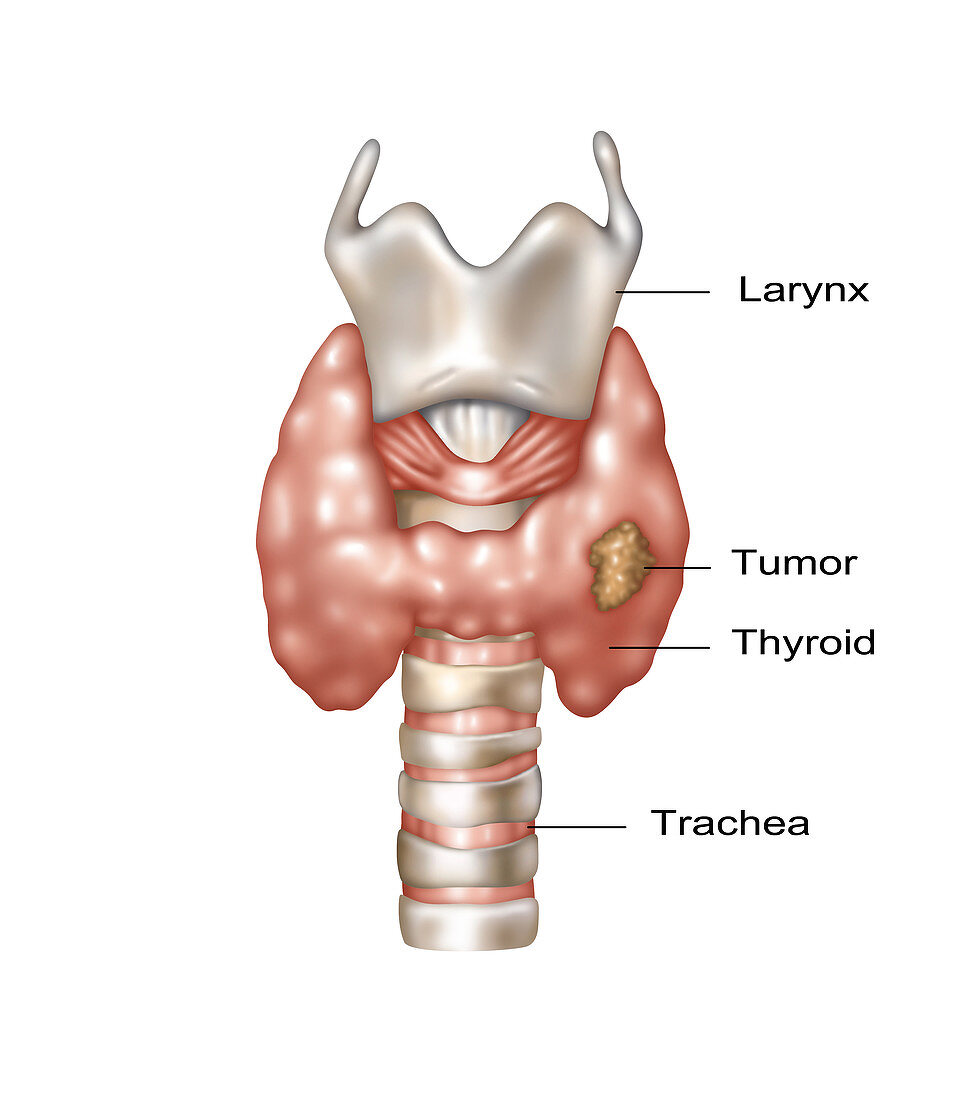Thyroid Cancer, Illustration