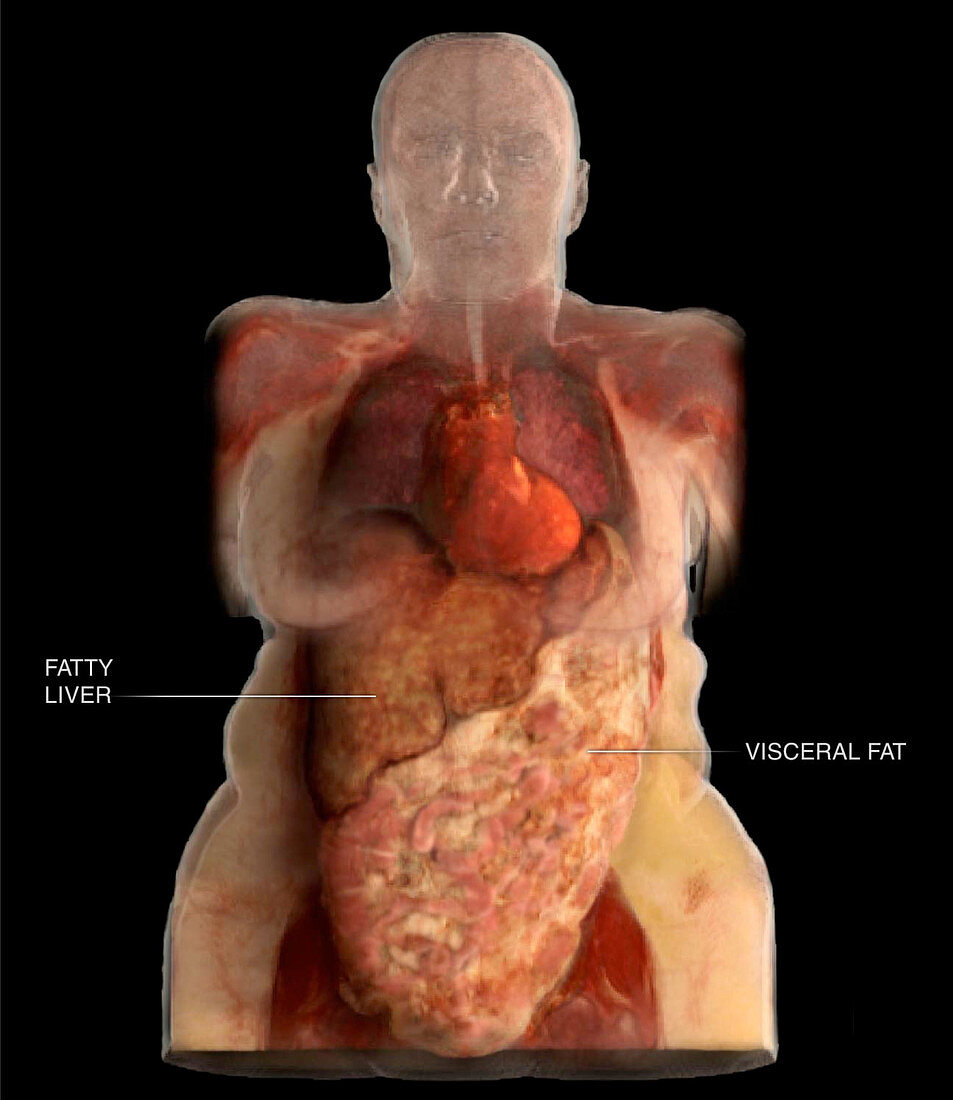 Fatty Liver Disease and Visceral Fat