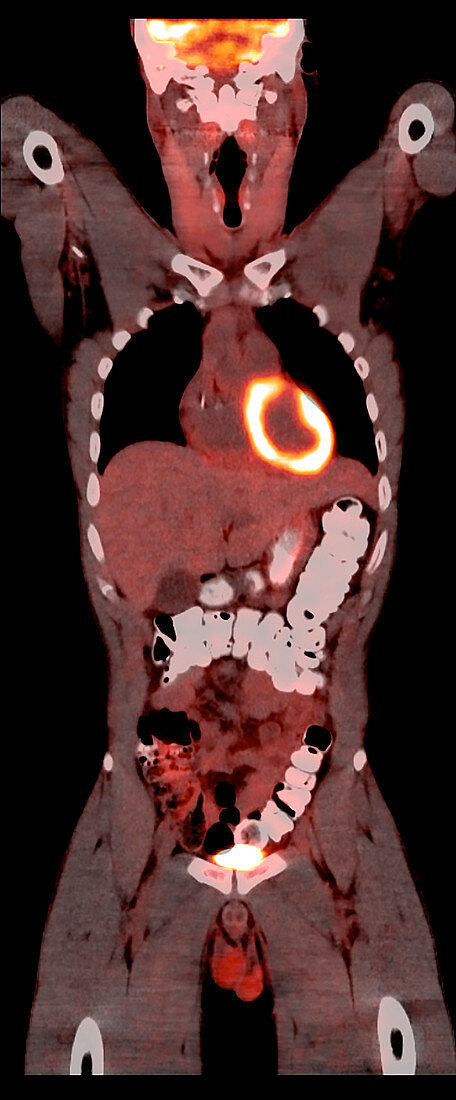 Normal PET CT Scan of Adult Male