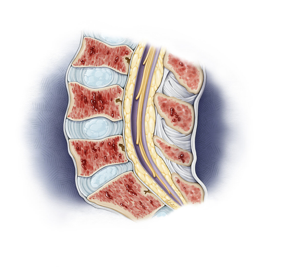 Multiple Myeloma in Lumbar Spine