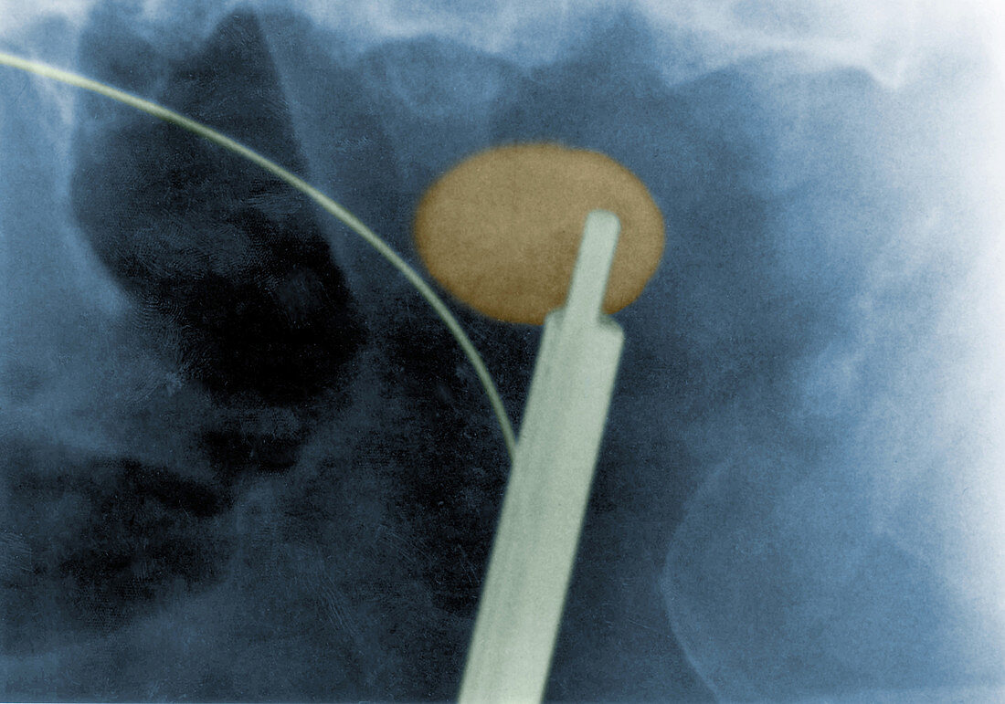 Kidney Stone and Ureteroscope
