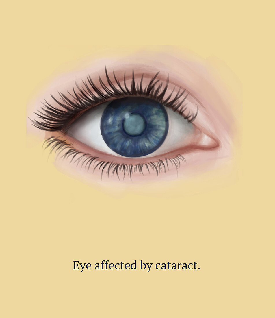 Eye Before Cataract Surgery, 1 of 6, Illustration