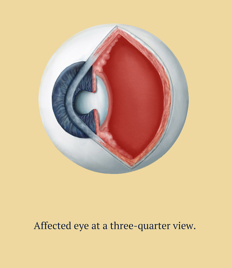 Cataract Surgery, 2 of 6, Illustration