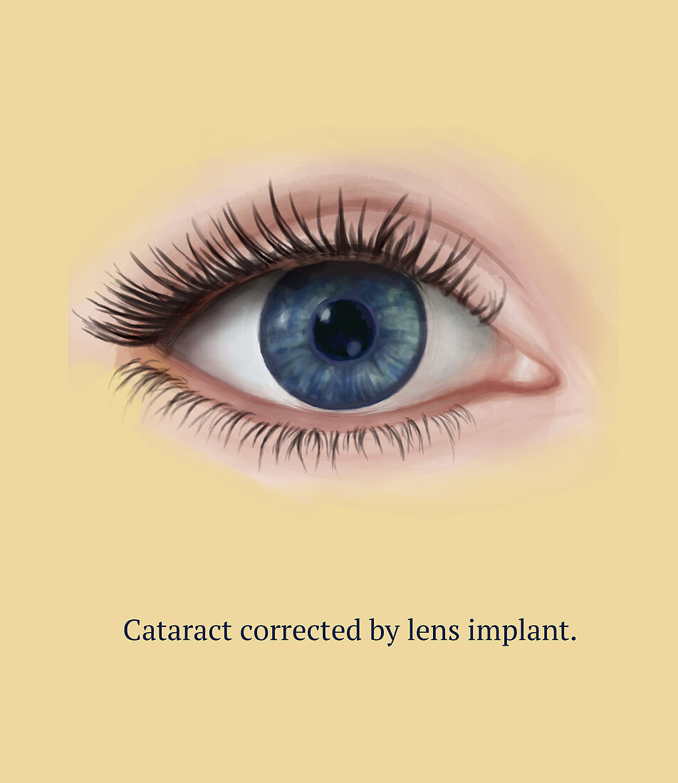 Eye After Cataract Surgery, 6 of 6, Illustration