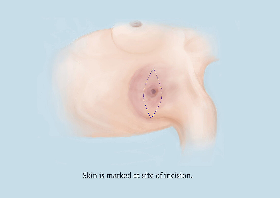 Mastectomy, Step 2 of 8, Illustration