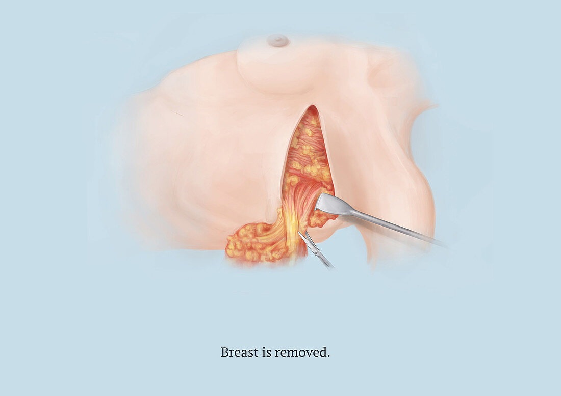 Mastectomy, Step 6 of 8, Illustration