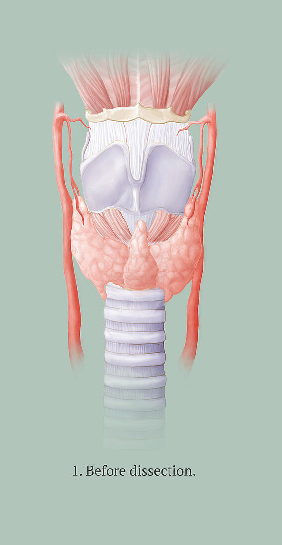 Thyroidectomy, 1 of 5