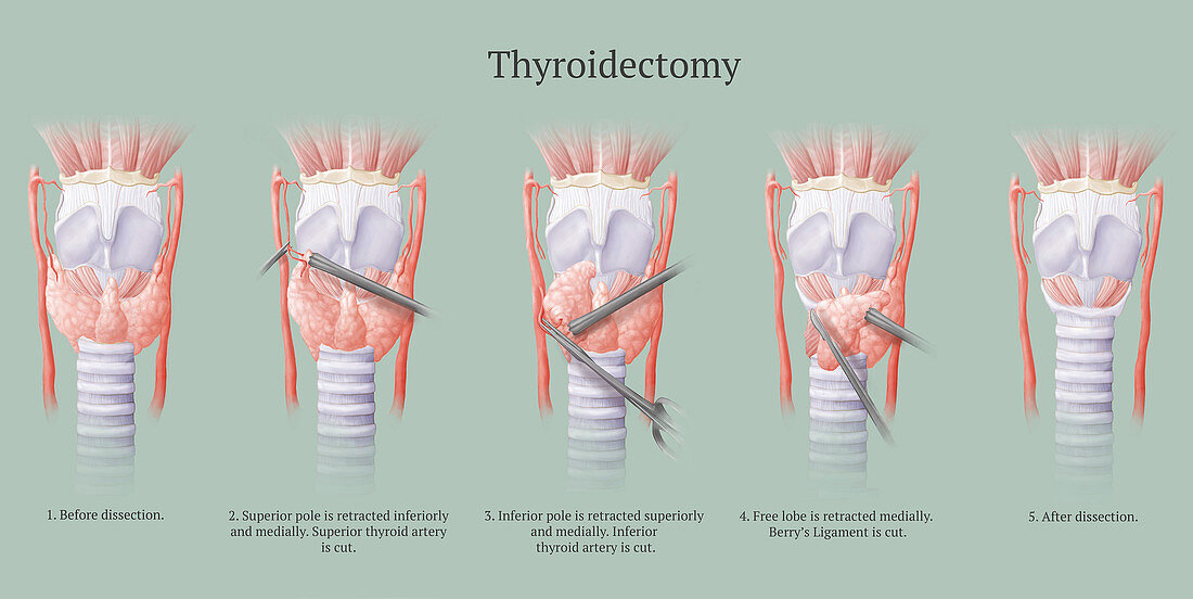 Thyroidectomy Procedure, Illustration