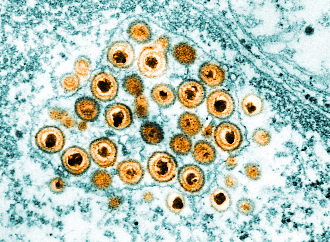 Herpes Simplex Virus, TEM