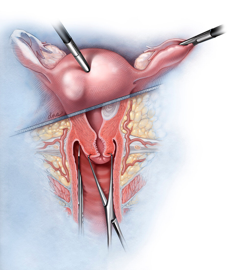 Route of Hysterectomy