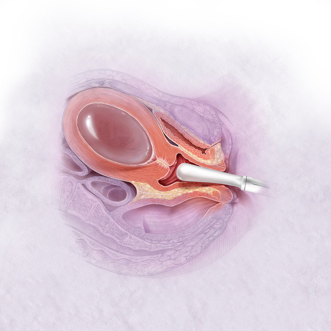 Ultrasound Screening for Short Cervix