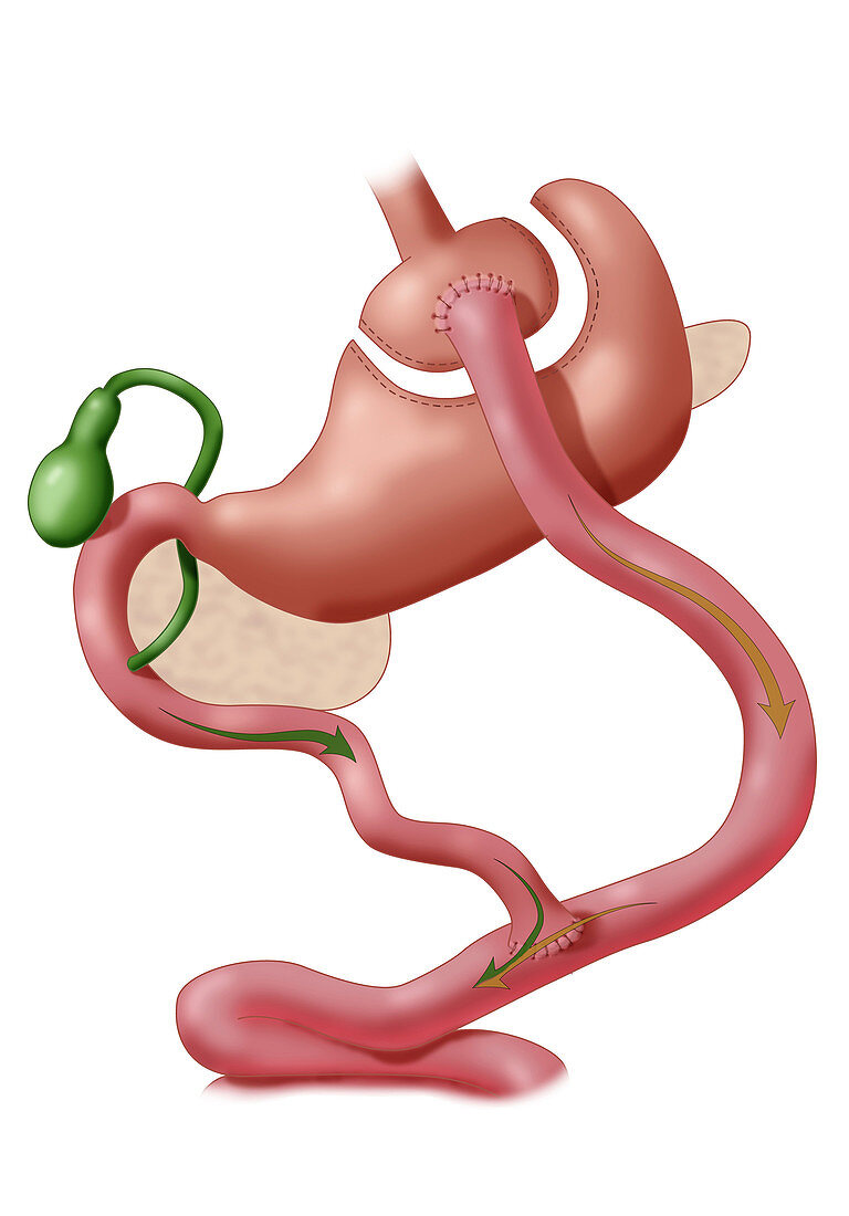 Roux-en-Y Gastric Bypass Surgery, Illustration