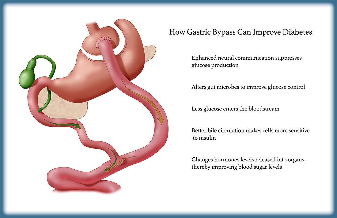 Gastric Surgery for Diabetes