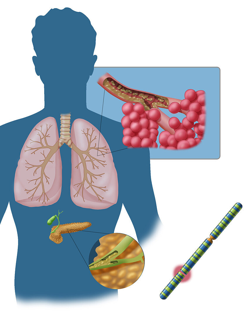 Cystic Fibrosis, Illustration