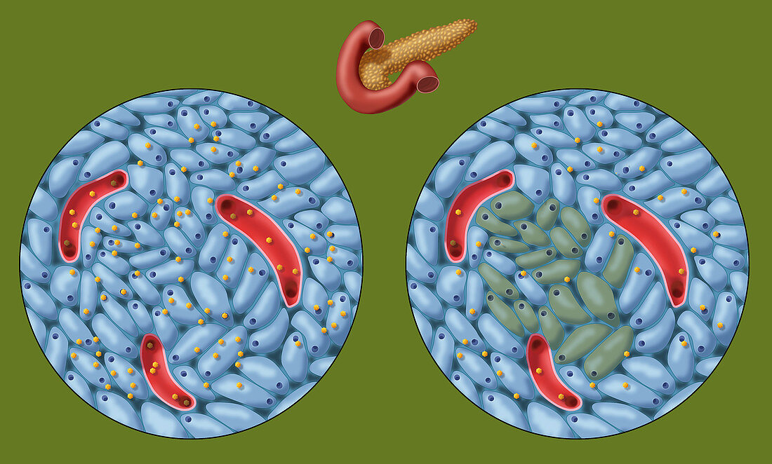 Type 1 Diabetes, Islets of Langerhans