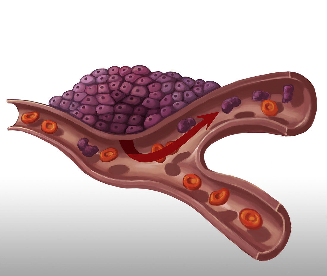 Tumor Development, Illustration