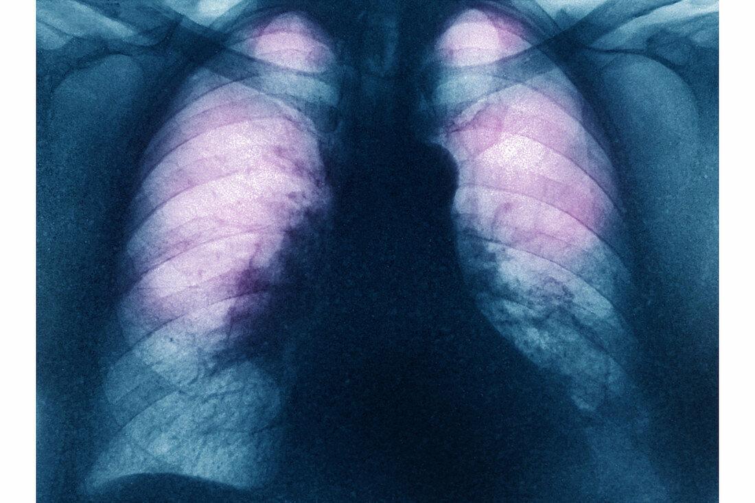 Pulmonary Embolism, X-ray