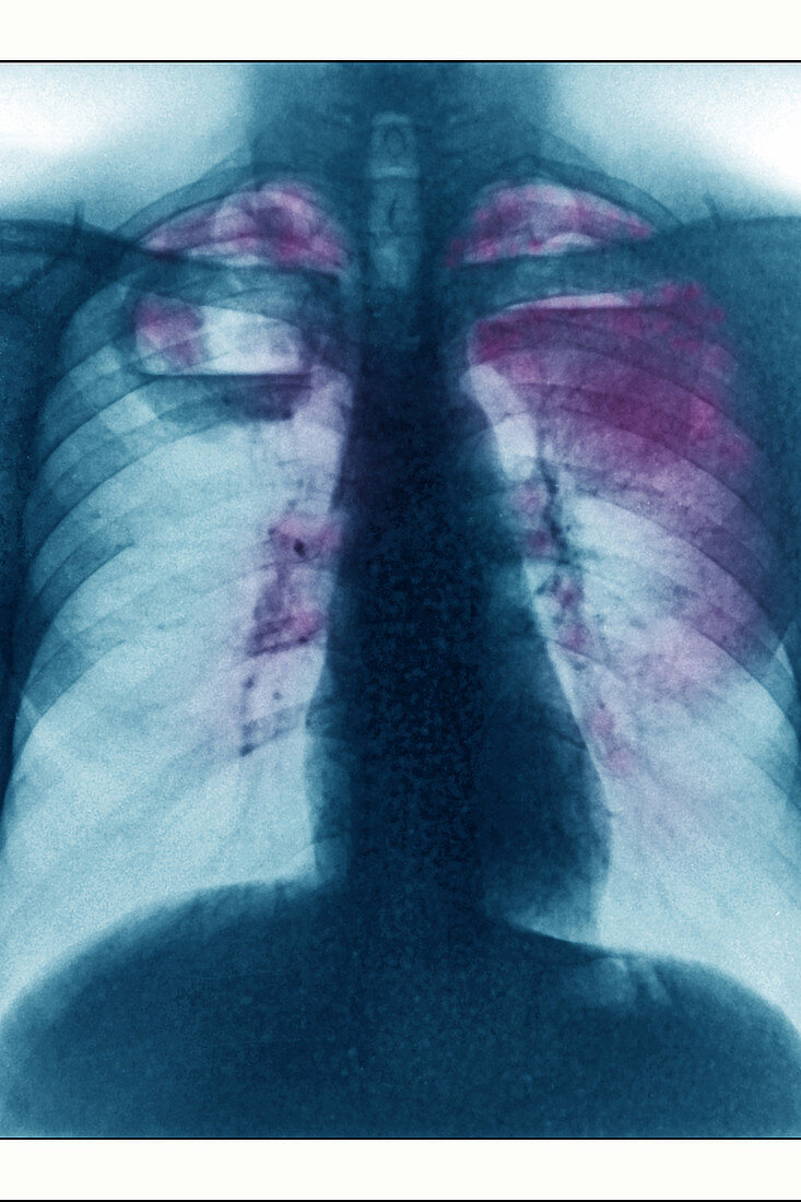 Wegener's Disease, X-ray