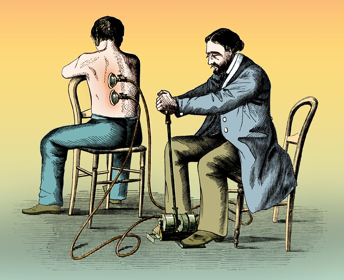 Cupping Therapy, 1862