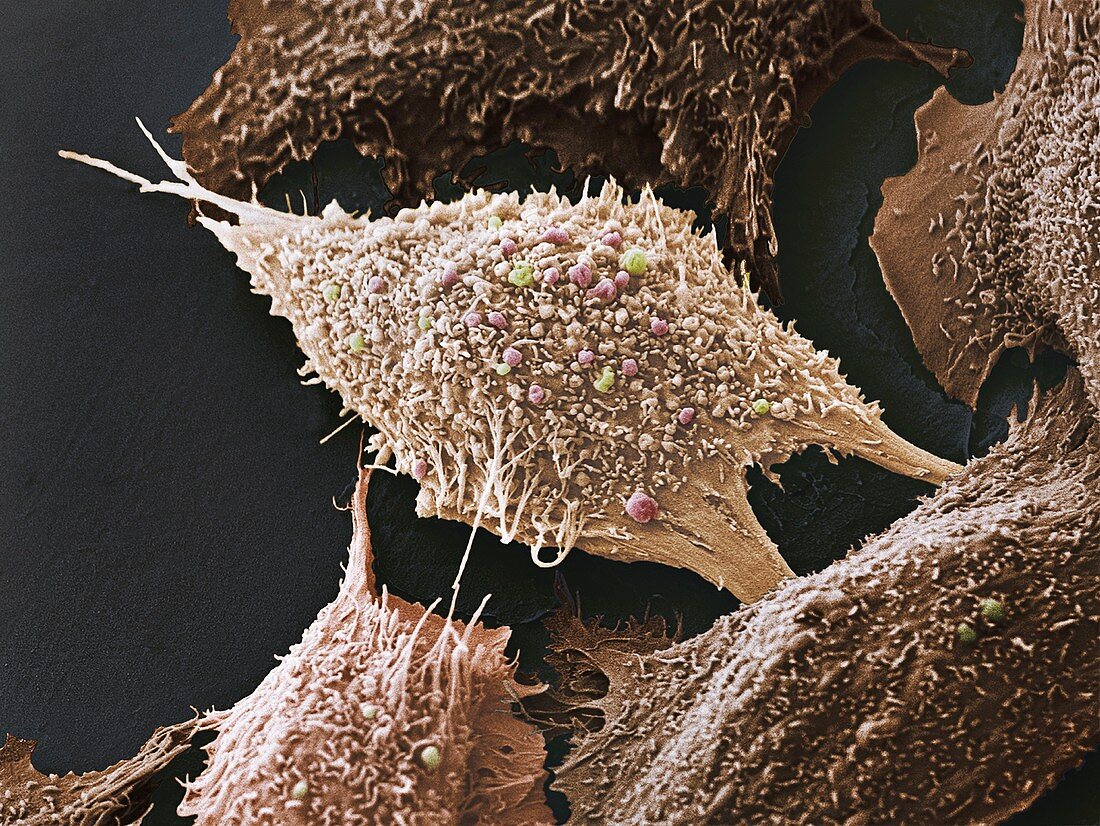 Lung cancer cells, SEM