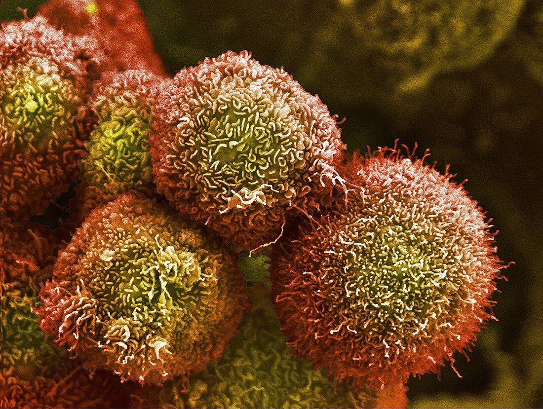 Pancreatic cancer cells, SEM