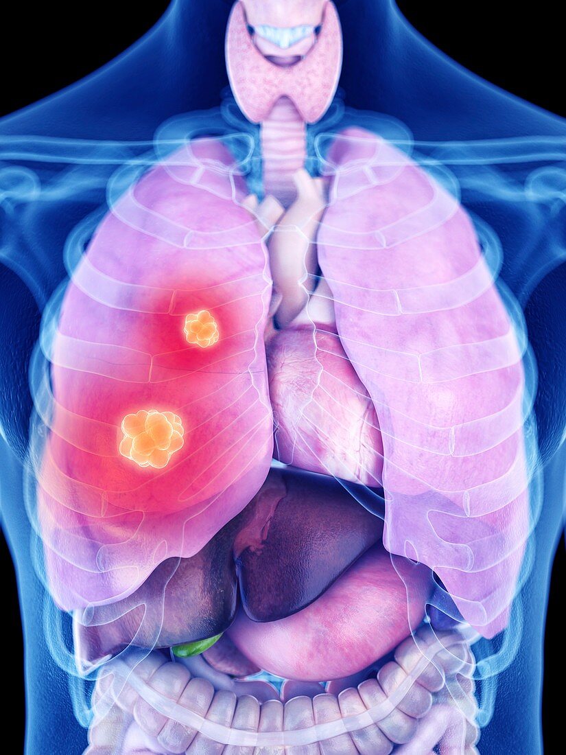 Illustration of lung cancer