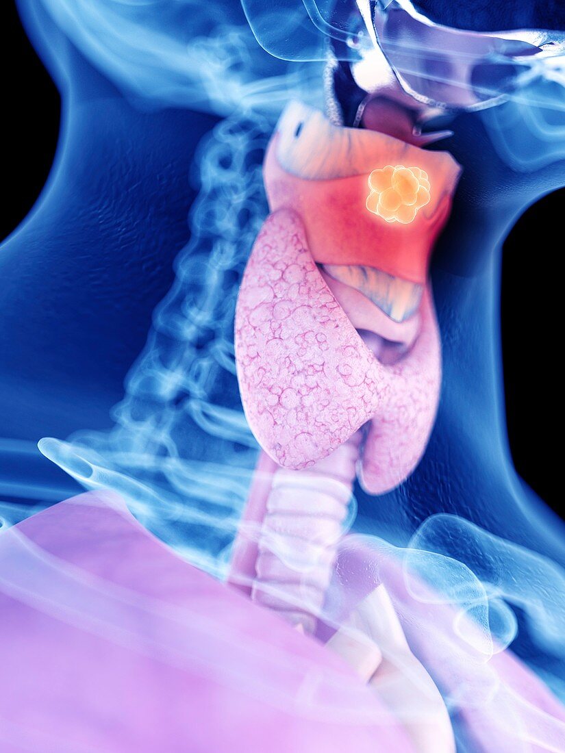 Illustration of larynx cancer