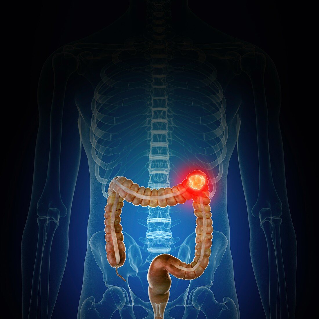 Illustration of colon cancer