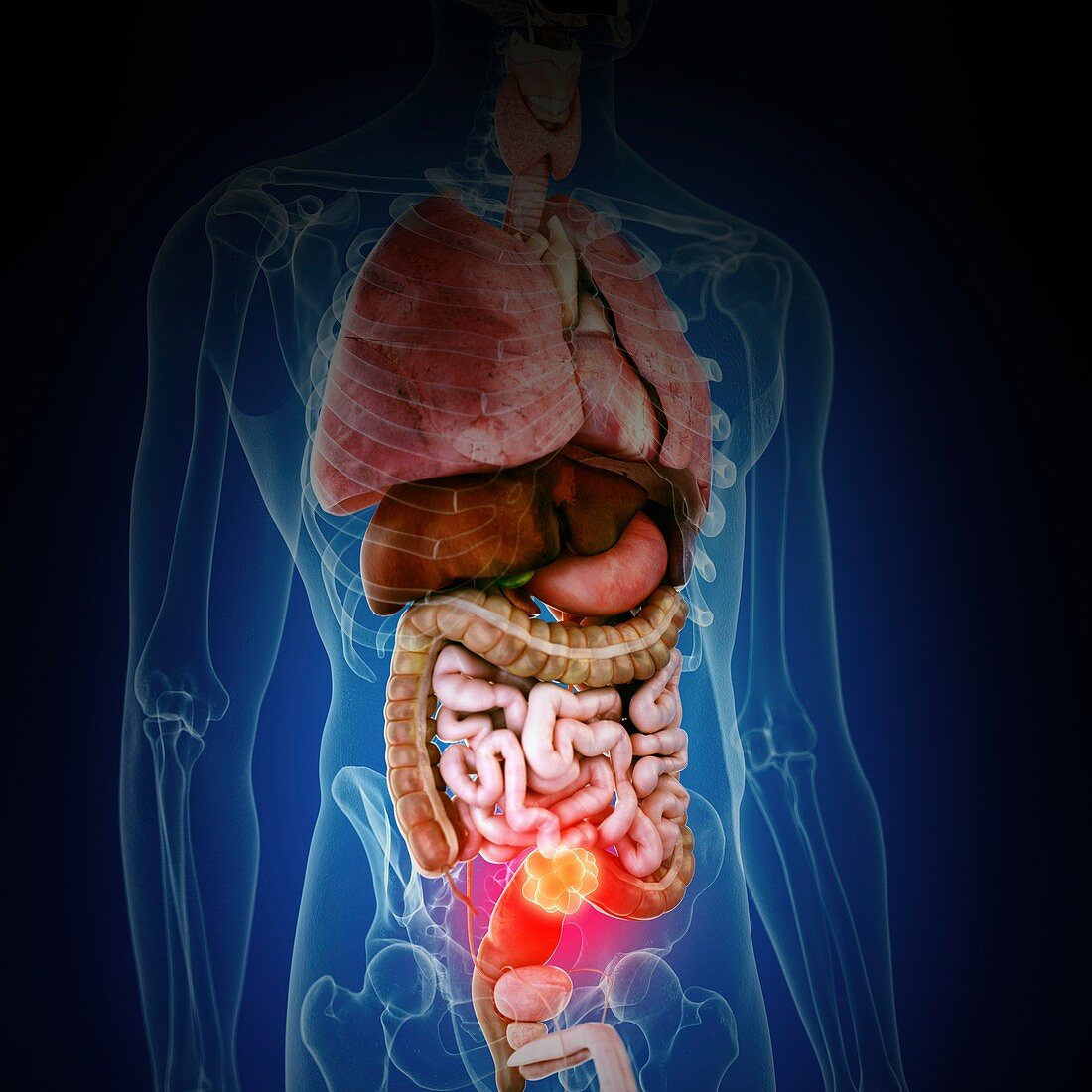 Illustration of colon cancer