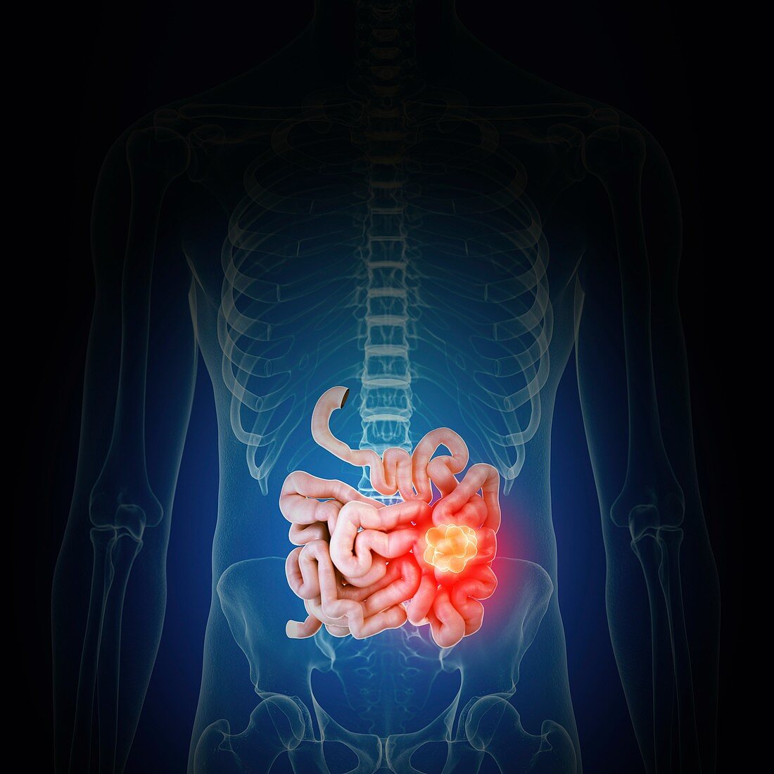 Illustration of intestine cancer