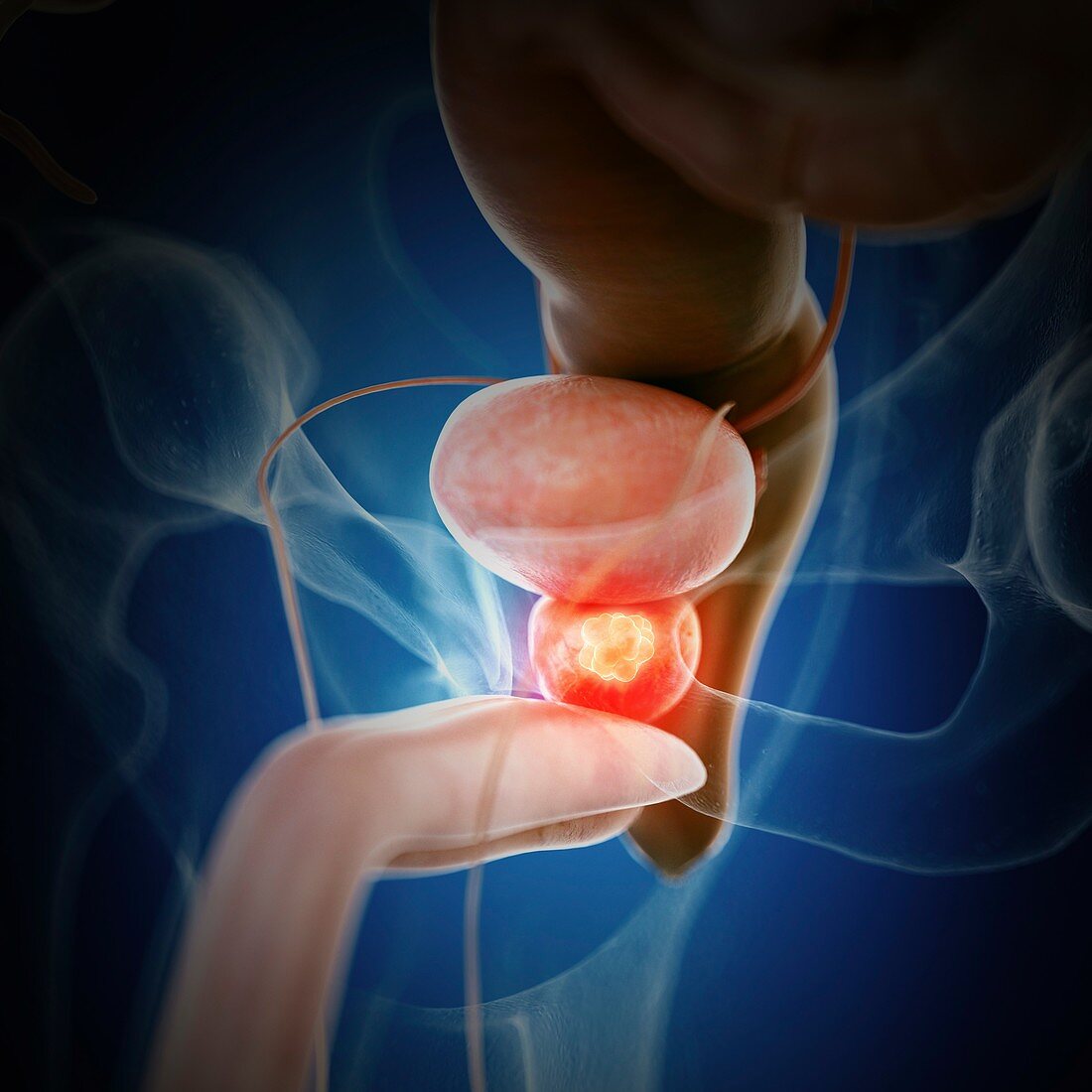 Illustration of prostate cancer